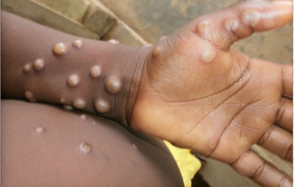 The first monkeypox case in the US this year reported in Massachusetts