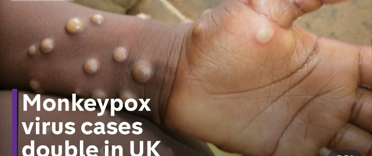 Another pandemic? WHO may declare monkeypox a ‘global emergency’