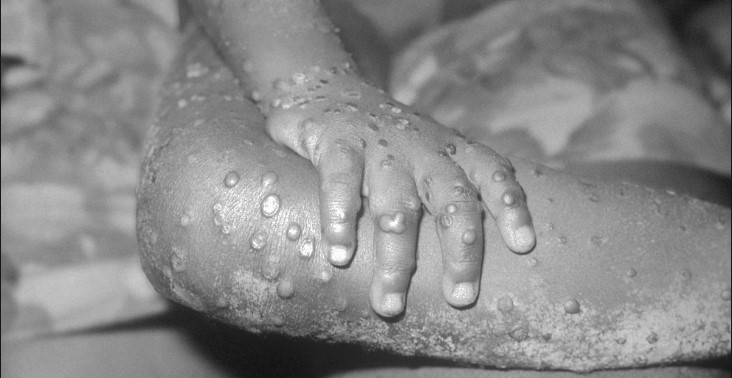 Monkeypox: After nine deaths, WHO says more fatalities may follow